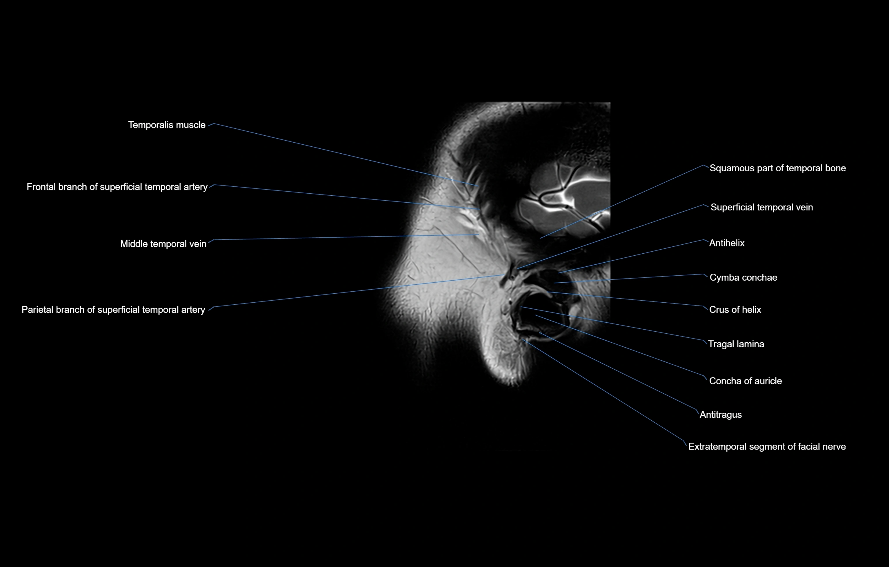 paranasal sinuses(PNS) MRI coronal  cross sectional anatomy 3T radiology  image-img-00001-00026.webp